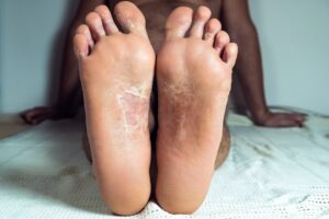 Why See a Podiatrist for Plantar Warts